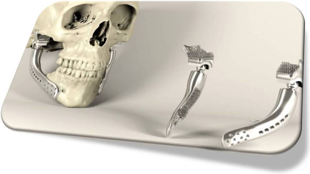 3D PRINTING OF IMPLANTS 