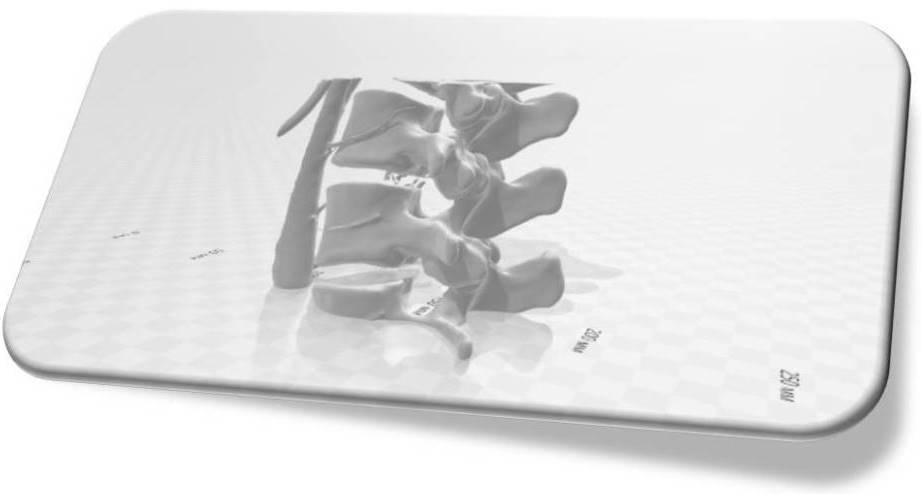 "EXTRACTION" OF BONES FROM DICOM FILES